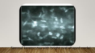 (Fig. 5.5).
Stromal keratocytes with bright oval-shaped nuclei
 