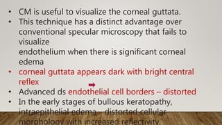 • CM is useful to visualize the corneal guttata.
• This technique has a distinct advantage over
conventional specular microscopy that fails to
visualize
endothelium when there is significant corneal
edema
• corneal guttata appears dark with bright central
reflex
• Advanced ds endothelial cell borders – distorted
• In the early stages of bullous keratopathy,
intraepithelial edema distorted cellular
morphology with increased reflectivity.
 