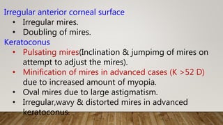 Irregular anterior corneal surface
• Irregular mires.
• Doubling of mires.
Keratoconus
• Pulsating mires(Inclination & jumpimg of mires on
attempt to adjust the mires).
• Minification of mires in advanced cases (K >52 D)
due to increased amount of myopia.
• Oval mires due to large astigmatism.
• Irregular,wavy & distorted mires in advanced
keratoconus.
 