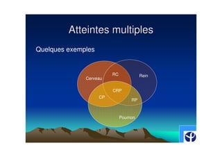 Atteintes multiples
Quelques exemples


                         RC            Rein
              Cerveau

                         CRP
                    CP
                                  RP



                              Poumon
 