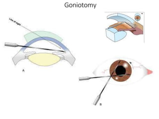 Goniotomy
 