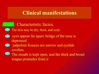 Characteristic facies. Clinical  manifestations The skin may be dry, thick, and scaly  eyes appear far apart; bridge of the nose is depressed  palpebral fissures are narrow and eyelids swollen.  The mouth is kept open, and the thick and broad tongue protrudes from it  