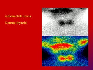 radionuclide scans  Normal thyroid 