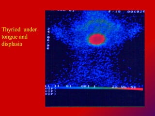 Thyriod  under tongue and displasia 