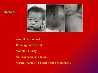 mental  is normal.  Bone age is normal.  Skeletal X –ray No characteristic facies  Serum levels of T4 and TSH are normal.   Rickets  