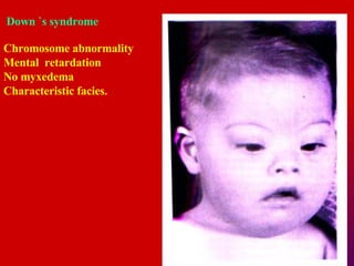 Down `s syndrome Chromosome abnormality Mental  retardation   No myxedema   Characteristic facies.  
