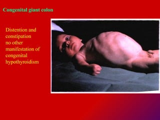 Congenital giant colon   Distention and constipation no other manifestation of congenital hypothyroidism  