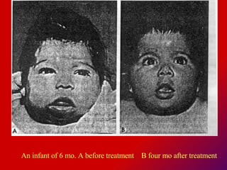 An infant of 6 mo. A before treatment  B four mo after treatment  