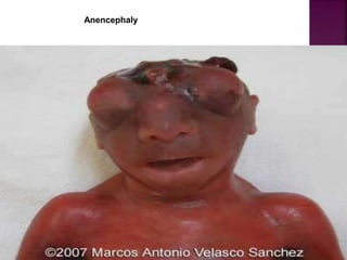 Brainless Child Congenital anomalies of foetus | PPT