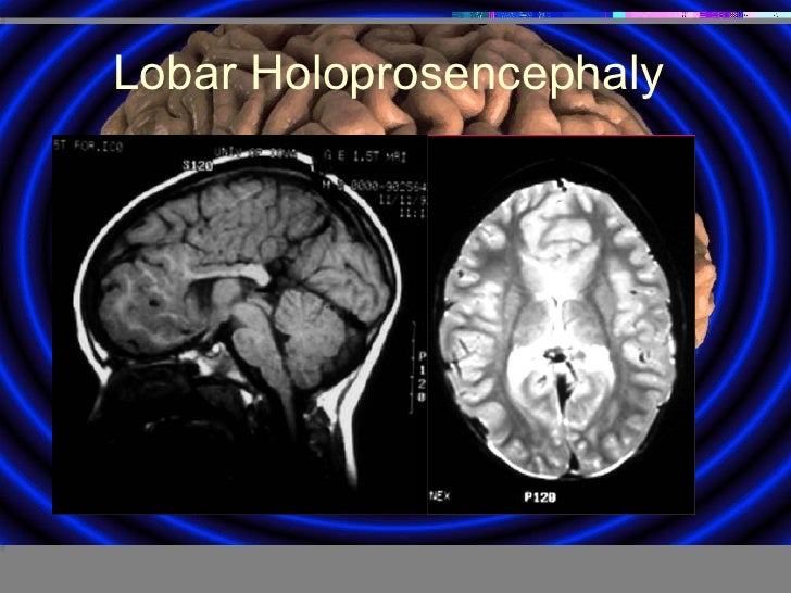 Congenital Brain Malformation