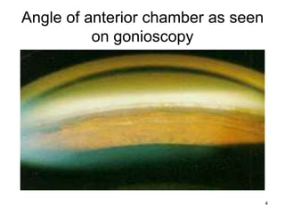 Congenital-glaucoma-final.pptx