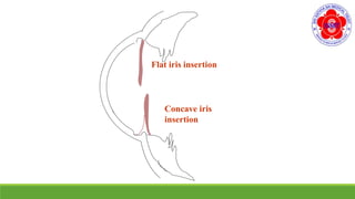 Flat iris insertion
Concave iris
insertion
 