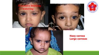 Excessive blinking
+/- watering
Hazy cornea
Large corneas
 