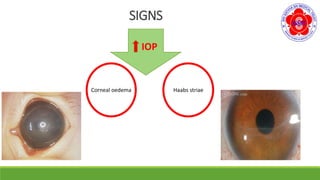 SIGNS
IOP
Corneal oedema Haabs striae
 