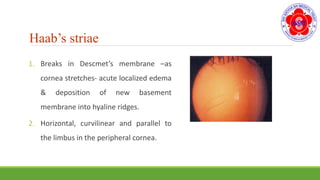 1. Breaks in Descmet’s membrane –as
cornea stretches- acute localized edema
& deposition of new basement
membrane into hyaline ridges.
2. Horizontal, curvilinear and parallel to
the limbus in the peripheral cornea.
Haab’s striae
 