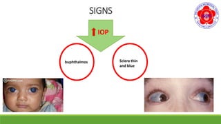 SIGNS
IOP
buphthalmos Sclera thin
and blue
 