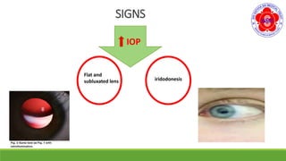 SIGNS
IOP
Flat and
subluxated lens iridodonesis
 