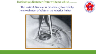 Horizontal diameter from white to white……..
The vertical diameter is fallaciously lowered by
encroachment of sclera at the superior limbus
 