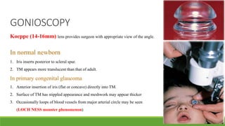 GONIOSCOPY
Koeppe (14-16mm) lens provides surgeon with appropriate view of the angle.
In normal newborn
1. Iris inserts posterior to scleral spur.
2. TM appears more translucent than that of adult.
In primary congenital glaucoma
1. Anterior insertion of iris (flat or concave) directly into TM.
2. Surface of TM has stippled appearance and meshwork may appear thicker
3. Occasionally loops of blood vessels from major arterial circle may be seen
(LOCH NESS monster phenomenon)
 