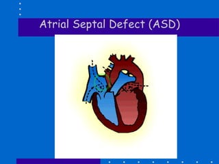 Atrial Septal Defect (ASD) 