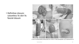 Approach to Congenital abdominal wall defects .pptx