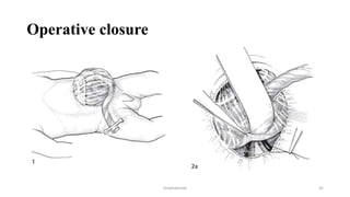 Approach to Congenital abdominal wall defects .pptx