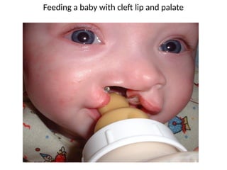 Feeding a baby with cleft lip and palate
 