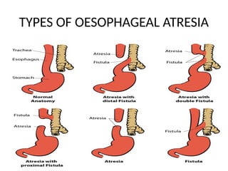 TYPES OF OESOPHAGEAL ATRESIA
 
