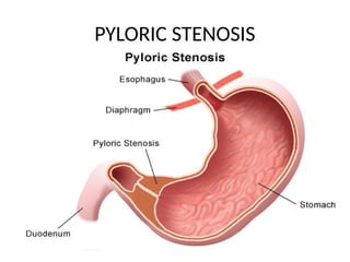 PYLORIC STENOSIS
 