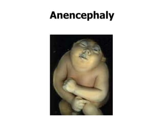 Brainless Child CONGENITAL ABNORMALITIES OR (1) - Copy.pptx