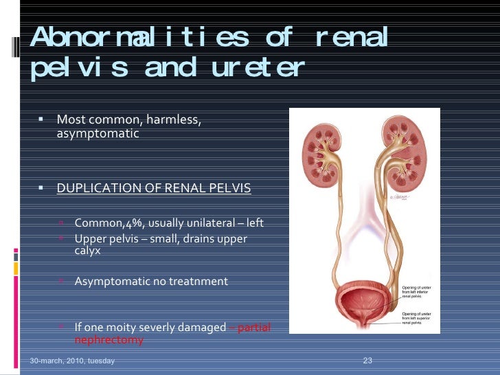 Nonneoplastic Disorders Of The Renal Pelvis And Ureter Radiology Key