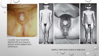 CLASSIC SALT WASTING
PHENOTYPE INA FEMALE
INFANT WITH AMBIGUOUS
GENITALIA
SIMPLE VIRILISING FORM IN SIBLINGS
 