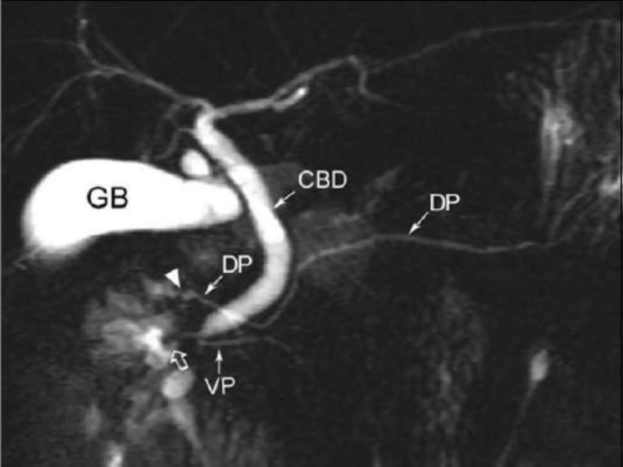 Congenital anamolies of pancrease | PPTX