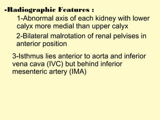 -Radiographic Features :
1-Abnormal axis of each kidney with lower
calyx more medial than upper calyx
2-Bilateral malrotation of renal pelvises in
anterior position
3-Isthmus lies anterior to aorta and inferior
vena cava (IVC) but behind inferior
mesenteric artery (IMA)
 