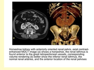 Horseshoe kidney with anteriorly oriented renal pelvis, axial contrast-
enhanced MDCT image (a) shows a horseshoe, the renal isthmus is
found anterior to the great retroperitoneal vessels, corresponding
volume rendering (b) better show the inferior renal isthmus, the
normal renal arteries, and the anterior location of the renal pelvises
 