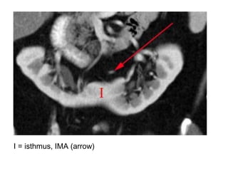 I = isthmus, IMA (arrow)
 