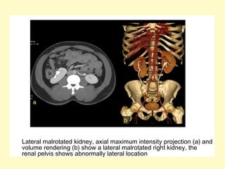 Lateral malrotated kidney, axial maximum intensity projection (a) and
volume rendering (b) show a lateral malrotated right kidney, the
renal pelvis shows abnormally lateral location
 
