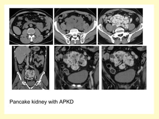 Pancake kidney with APKD
 