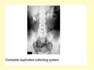Complete duplicated collecting system
 