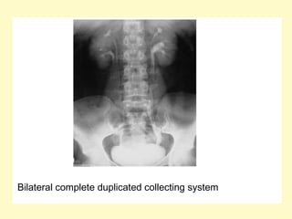 Bilateral complete duplicated collecting system
 
