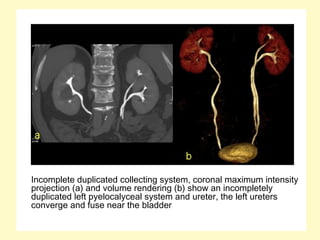 Incomplete duplicated collecting system, coronal maximum intensity
projection (a) and volume rendering (b) show an incompletely
duplicated left pyelocalyceal system and ureter, the left ureters
converge and fuse near the bladder
 