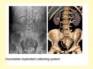 Incomplete duplicated collecting system
 