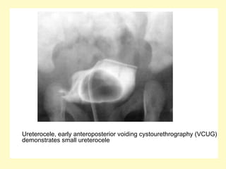 Ureterocele, early anteroposterior voiding cystourethrography (VCUG)
demonstrates small ureterocele
 