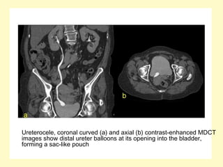Ureterocele, coronal curved (a) and axial (b) contrast-enhanced MDCT
images show distal ureter balloons at its opening into the bladder,
forming a sac-like pouch
 