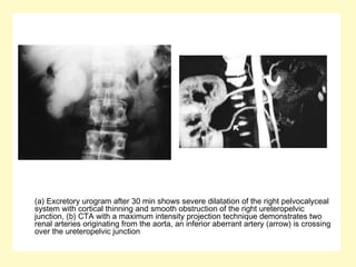 (a) Excretory urogram after 30 min shows severe dilatation of the right pelvocalyceal
system with cortical thinning and smooth obstruction of the right ureteropelvic
junction, (b) CTA with a maximum intensity projection technique demonstrates two
renal arteries originating from the aorta, an inferior aberrant artery (arrow) is crossing
over the ureteropelvic junction
 