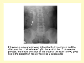 Intravenous urogram showing right-sided hydronephrosis and the
dilation of the proximal ureter up to the level of the L3 transverse
process, the medial deviation of the ureter at this level (arrow) gives
rise to the typical fish hook or reversed S appearance
 