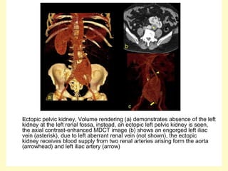 Ectopic pelvic kidney, Volume rendering (a) demonstrates absence of the left
kidney at the left renal fossa, instead, an ectopic left pelvic kidney is seen,
the axial contrast-enhanced MDCT image (b) shows an engorged left iliac
vein (asterisk), due to left aberrant renal vein (not shown), the ectopic
kidney receives blood supply from two renal arteries arising form the aorta
(arrowhead) and left iliac artery (arrow)
 