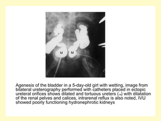 Agenesis of the bladder in a 5-day-old girl with wetting, image from
bilateral ureterography performed with catheters placed in ectopic
ureteral orifices shows dilated and tortuous ureters (u) with dilatation
of the renal pelves and calices, intrarenal reflux is also noted, IVU
showed poorly functioning hydronephrotic kidneys
 