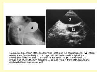 Complete duplication of the bladder and urethra in the coronal plane, (a) Lateral
retrograde cystourethrogram through both separate urethral openings
shows two bladders, one (a) anterior to the other (b), (b) Transverse US
image also shows the two bladders (a, b), one lying in front of the other and
each with its own muscular wall
 