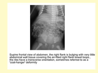 Supine frontal view of abdomen, the right flank is bulging with very little
abdominal wall tissue covering the air-filled right flank bowel loops.,
the ribs have a transverse orientation, sometimes referred to as a
'coat-hanger' deformity
 